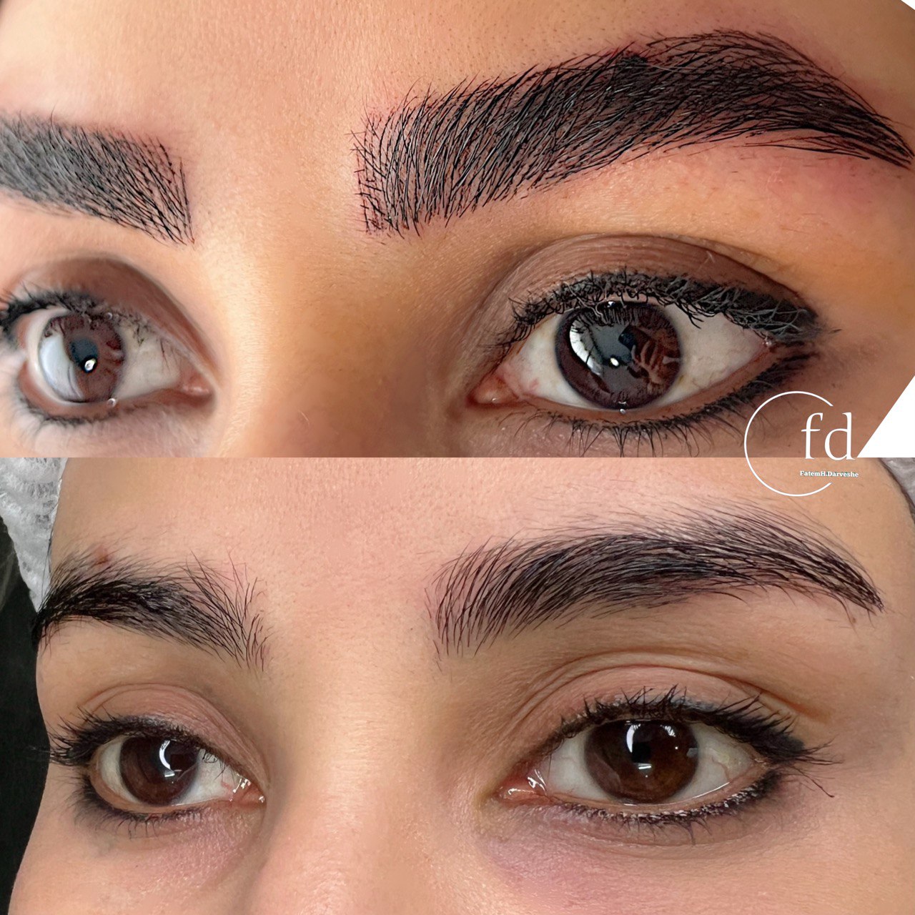 بررسی عوارض میکروبلیدینگ و راه‌های پیشگیری