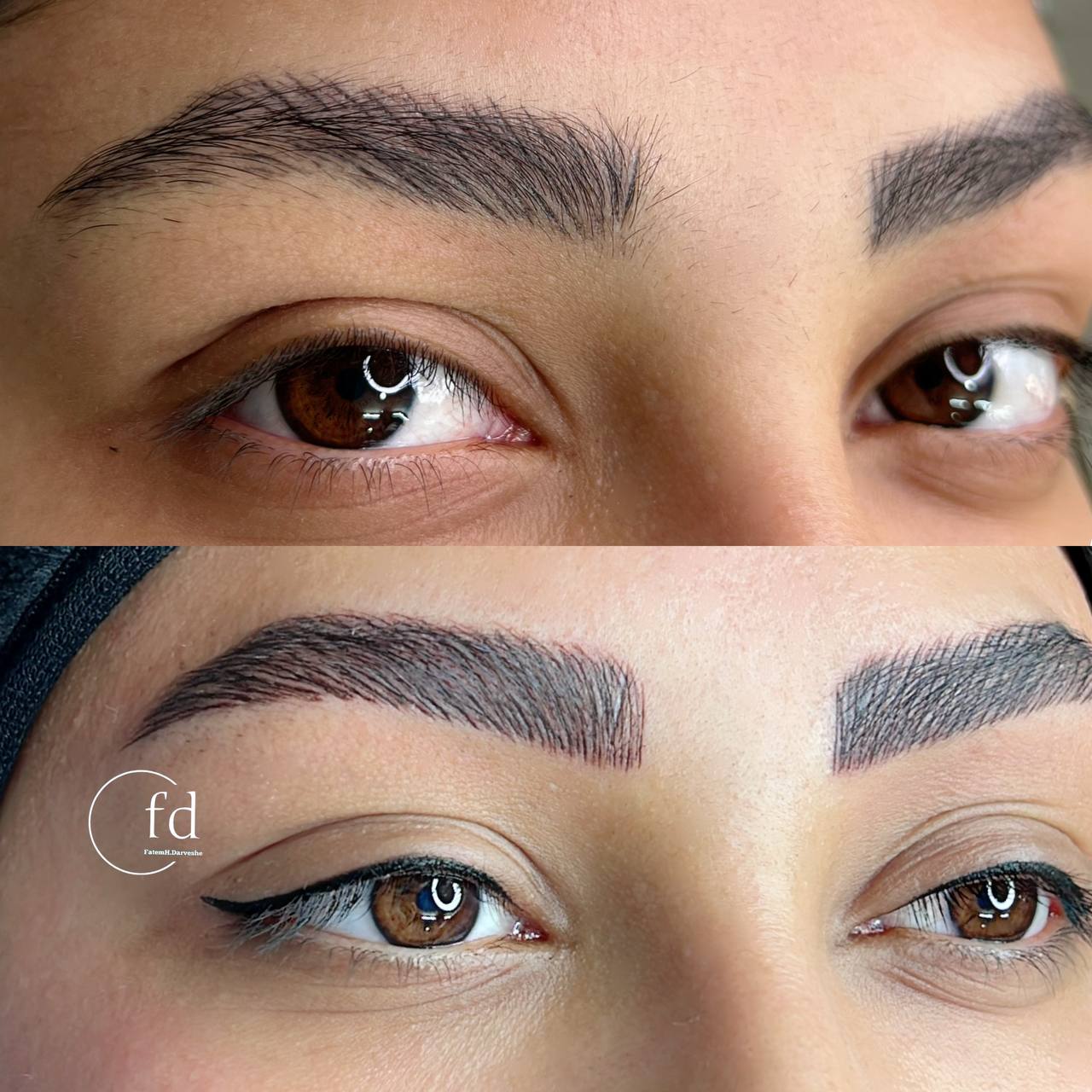 ماندگاری میکروبلیدینگ و فیبروز ابرو